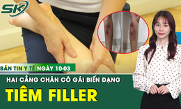 Bản Tin Y Tế 10/3: Tiêm filler để làm thẳng chân, cô gái 29 tuổi biến dạng cẳng chân