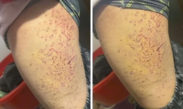 Xác minh thông tin học sinh bị bạn 'đâm' gây thương tích ở Lào Cai