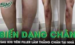Cô gái 29 tuổi biến dạng hai cẳng chân sau khi tiêm filler làm thẳng chân tại nhà