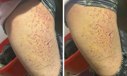 Đã rõ nguyên nhân học sinh lớp 7 ở Lào Cai bị bạn cùng lớp dùng bút đâm vào đùi