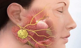 U tuyến mang tai có biểu hiện như thế nào?