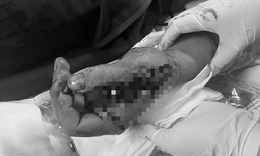 Tai nạn trong tích tắc vì pháo nổ, nam thanh niên suýt mất chức năng bàn tay