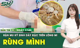Bản tin Y tế 17/3: Rùng mình rận mu ký sinh dày đặc trên lông mi người phụ nữ 