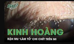 Ngứa mắt tưởng viêm nhẹ, người phụ nữ sốc khi bác sĩ phát hiện rận mu “làm tổ” kín lông mi