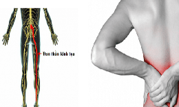 Vitamin và khoáng chất nào tốt cho người đau thần kinh tọa?