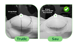 Vỡ túi ngực sớm, nguyên nhân do đâu?