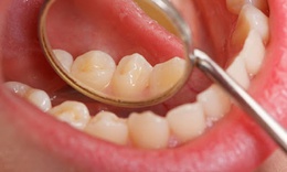 Ngoài thuốc lá, yếu tố nào làm tăng nguy cơ ung thư khoang miệng?