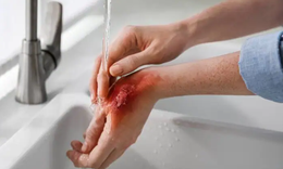 Sơ cứu bỏng đúng cách hạn chế biến chứng và sẹo