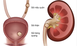5 nguyên nhân làm tăng nguy cơ sỏi niệu quản và cách phòng ngừa hiệu quả