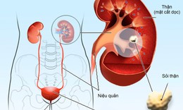Cách phòng ngừa sỏi thận không dùng thuốc