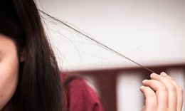 Tật giật, nhổ tóc gây tổn thương da đầu và sức khoẻ tinh thần như thế nào?