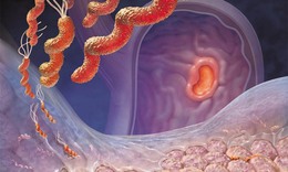 Viêm loét dạ dày – tá tràng: Dùng thuốc đúng cách để bảo vệ niêm mạc