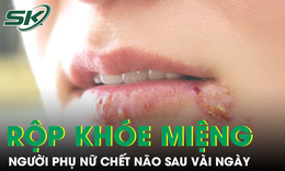 Chủ quan với loét miệng thông thường, người phụ nữ chết não sau vài ngày