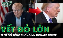 Tổng thống Mỹ Donald Trump xuất hiện với vết đỏ lớn trên cổ gây đồn đoán về sức khỏe