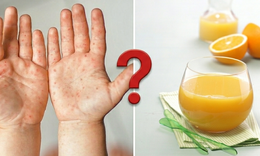 Nước cam tốt nhưng trẻ tay chân miệng nên tránh: Chuyên gia giải thích lý do