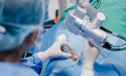 Xu hướng ghép giác mạc lớp chọn lọc bằng laser