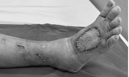 Cứu bàn chân bên bờ cắt cụt cho bệnh nhân đái tháo đường 20 năm