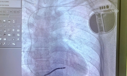 Người đàn ông 3 lần ngất, 1 lần ngưng tim, nguy cơ đột tử cao được cứu nhờ kỹ thuật lần đầu triển khai