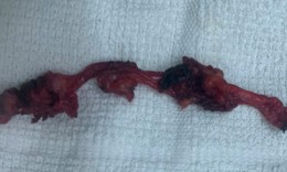 Đau âm ỉ vùng bụng, phát hiện bệnh hiếm nằm sát bàng quang