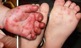 Tay chân miệng ở Khánh Hòa tăng gấp 4 lần năm ngoái, bác sĩ khuyến cáo điều phụ huynh cần làm ngay