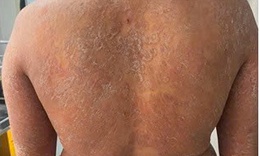 Dùng sai thuốc, nấm da lan toàn thân, ngứa dữ dội