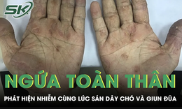 Ngứa toàn thân suốt 2 tháng, người đàn ông phát hiện nhiễm cùng lúc sán dây chó và giun đũa