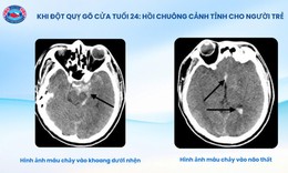 Bệnh viện Hữu nghị Việt Tiệp cứu sống bệnh nhân 24 tuổi bị đột quỵ