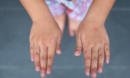 Các cấp độ bệnh tay chân miệng và dấu hiệu cảnh báo