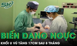 Khối u vú tăng 17cm sau 8 tháng khiến nữ du học sinh biến dạng ngực