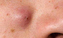 Có nên nặn mụn nhọt ở mặt không? những sai lầm dễ gây biến chứng