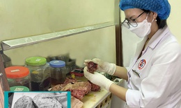 Người phụ nữ 46 tuổi mang trong mình khối u tử cung khổng lồ nặng 5kg