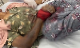 Liên tiếp ca nhập viện nguy kịch do rắn cắn, cách xử trí đúng tránh biến chứng