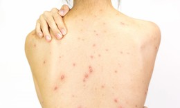 Nguyên nhân mọc mụn trứng cá ở lưng, yếu tố thường gặp nhưng dễ bị bỏ qua