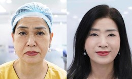 Căng da mặt - khi trẻ hóa không còn là 'kéo da' đơn thuần