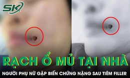 Rạch ổ mủ tại nhà, người phụ nữ gặp biến chứng nặng sau tiêm filler