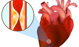 Bỗng dưng bị đau thắt ngực, cảnh giác với nhồi máu cơ tim