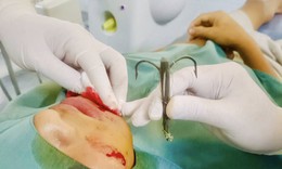 Đi câu cá, lưỡi câu móc vào má