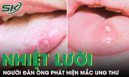 Người đàn ông phát hiện mắc ung thư từ dấu hiệu lạ ở lưỡi