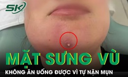 Nặn mụn cằm, người phụ nữ nhập viện vì mặt sưng vù, không ăn uống được 