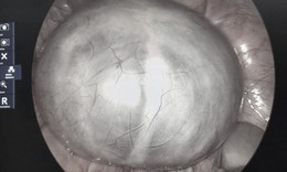 Chủ quan với cơn đau bụng, phát hiện u buồng trứng 14cm