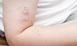 Điều trị đau dây thần kinh sau zona kéo dài