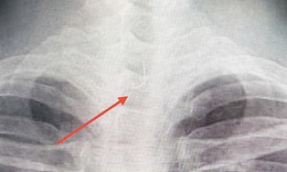 Sau ăn cá người đàn ông 46 tuổi bị mắc lưỡi câu sâu trong thực quản