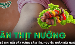 Bé trai nổi đầy mảng bầm tím sau bữa ăn thịt nướng, bác sĩ phát hiện nguyên nhân bất ngờ