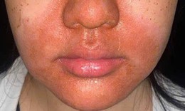 Peel da mặt làm đẹp, cô gái mọc chi chít mụn nước, vỡ chảy dịch