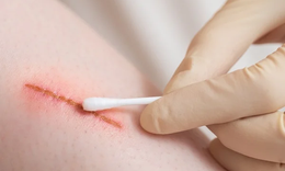 Đừng chủ quan với các vết trầy xước nhỏ