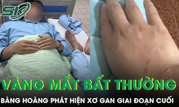 Da và mắt vàng bất thường, chàng trai 21 tuổi bàng hoàng phát hiện xơ gan giai đoạn cuối 