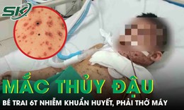 Biến chứng thủy đậu, bé trai 6 tuổi nhiễm khuẩn huyết, phải thở máy nguy kịch