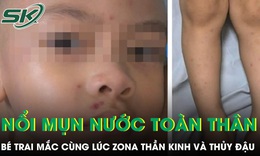 Bé trai 4 tuổi nổi kín mụn nước toàn thân sau khi mắc cùng lúc zona thần kinh và thủy đậu