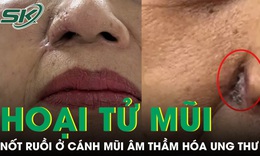 Nốt ruồi ở cánh mũi âm thầm hóa ung thư, phá hủy gần toàn bộ mũi người phụ nữ
