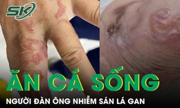 Ăn cá sống, người đàn ông bị nhiễm sán lá gan